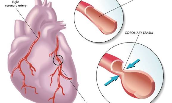 Mô phỏng cơ chế co thắt động mạch vành (Coronary Spasm) ở đau thắt ngực Prinzmetal