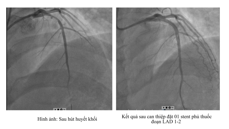 Sau hút huyết khối và đặt stent tái thông LAD