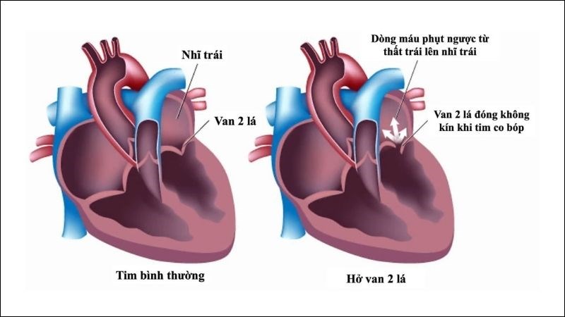 Sơ đồ so sánh giải phẫu tim bình thường và cơ chế dòng máu phụt ngược trong hở van hai lá