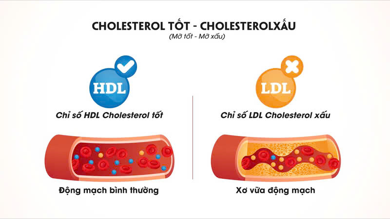 So sánh cholesterol tốt HDL và cholesterol xấu LDL gây xơ vữa động mạch